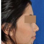 Rhinoplasty Before & After Patient #7309