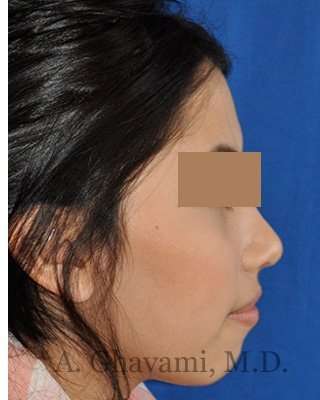 Rhinoplasty Before & After Patient #7309