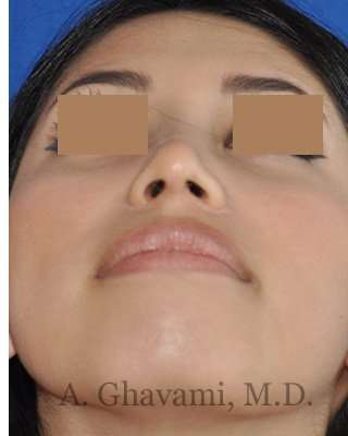 Rhinoplasty Before & After Patient #7309
