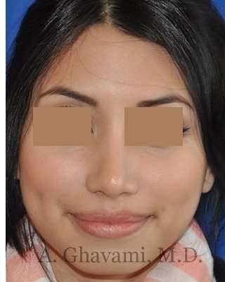 Rhinoplasty Before & After Patient #7309