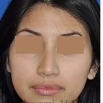 Rhinoplasty Before & After Patient #7309