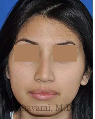 Rhinoplasty Before & After Patient #7309