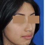Rhinoplasty Before & After Patient #7309