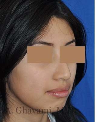 Rhinoplasty Before & After Patient #7309