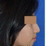 Rhinoplasty Before & After Patient #7309