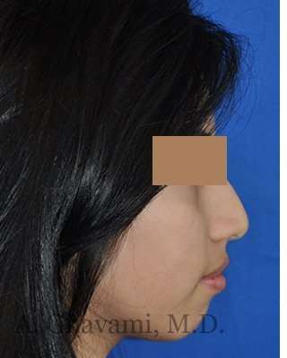 Rhinoplasty Before & After Patient #7309