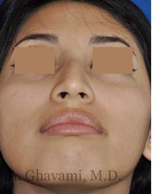 Rhinoplasty Before & After Patient #7309