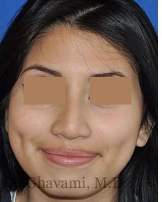 Rhinoplasty Before & After Patient #7309