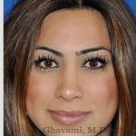Revision Rhinoplasty Before & After Patient #7298
