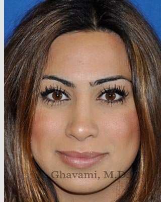 Revision Rhinoplasty Before & After Patient #7298