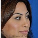 Revision Rhinoplasty Before & After Patient #7298