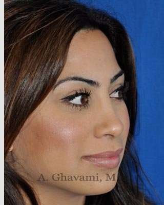 Revision Rhinoplasty Before & After Patient #7298