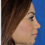 Revision Rhinoplasty Before & After Patient #7298