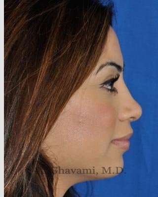 Revision Rhinoplasty Before & After Patient #7298