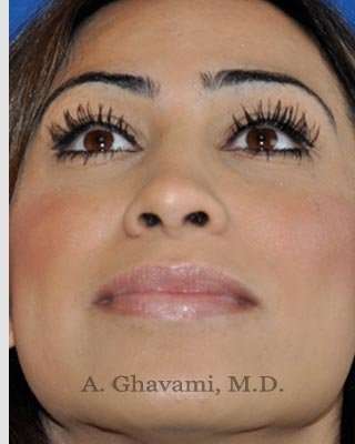 Revision Rhinoplasty Before & After Patient #7298