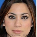 Revision Rhinoplasty Before & After Patient #7298