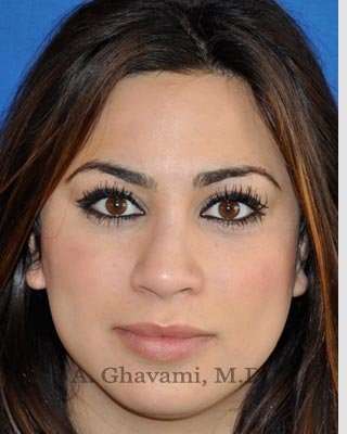 Revision Rhinoplasty Before & After Patient #7298