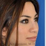 Revision Rhinoplasty Before & After Patient #7298