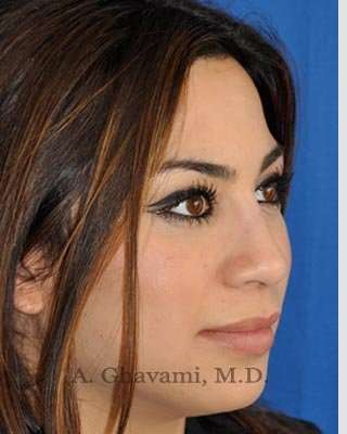 Revision Rhinoplasty Before & After Patient #7298