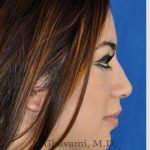 Revision Rhinoplasty Before & After Patient #7298