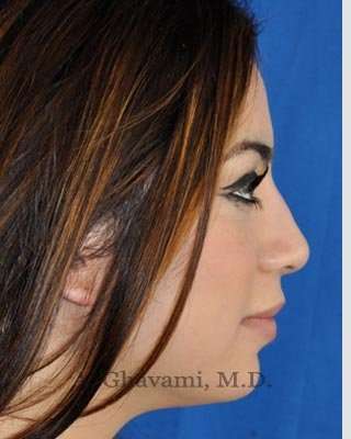 Revision Rhinoplasty Before & After Patient #7298