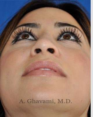 Revision Rhinoplasty Before & After Patient #7298