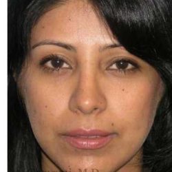 Ethnic Rhinoplasty Before & After Patient #7280