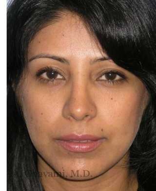 Ethnic Rhinoplasty Before & After Patient #7280
