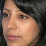 Ethnic Rhinoplasty Before & After Patient #7280