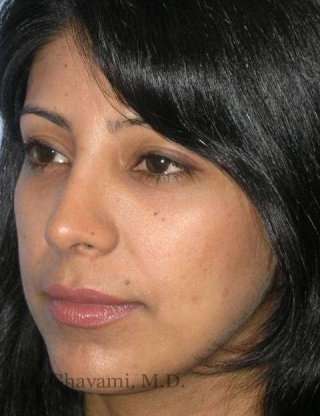 Ethnic Rhinoplasty Before & After Patient #7280