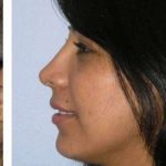 Ethnic Rhinoplasty Before & After Patient #7280