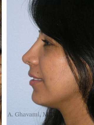 Ethnic Rhinoplasty Before & After Patient #7280