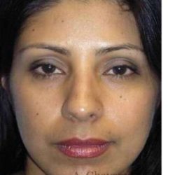 Ethnic Rhinoplasty Before & After Patient #7280
