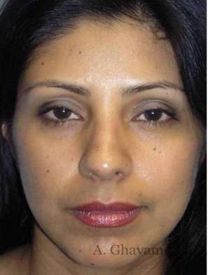 Ethnic Rhinoplasty Before & After Patient #7280