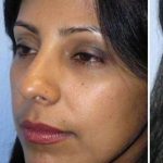 Ethnic Rhinoplasty Before & After Patient #7280