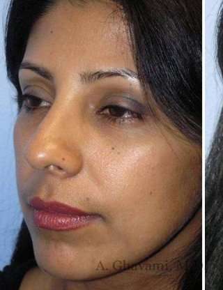Ethnic Rhinoplasty Before & After Patient #7280