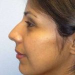 Ethnic Rhinoplasty Before & After Patient #7280