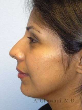 Ethnic Rhinoplasty Before & After Patient #7280