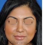 Ethnic Rhinoplasty Before & After Patient #7273