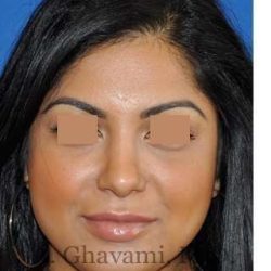 Ethnic Rhinoplasty Before & After Patient #7273