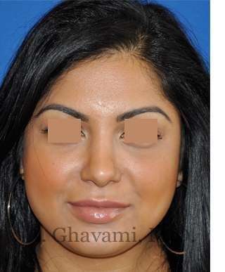 Ethnic Rhinoplasty Before & After Patient #7273