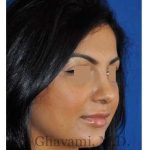 Ethnic Rhinoplasty Before & After Patient #7273