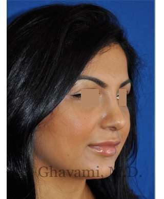 Ethnic Rhinoplasty Before & After Patient #7273