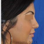 Ethnic Rhinoplasty Before & After Patient #7273