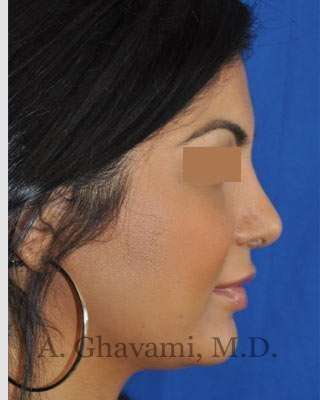 Ethnic Rhinoplasty Before & After Patient #7273