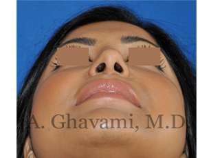 Ethnic Rhinoplasty Before & After Patient #7273