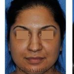 Ethnic Rhinoplasty Before & After Patient #7273