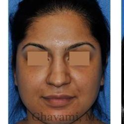 Ethnic Rhinoplasty Before & After Patient #7273