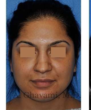 Ethnic Rhinoplasty Before & After Patient #7273
