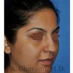 Ethnic Rhinoplasty Before & After Patient #7273